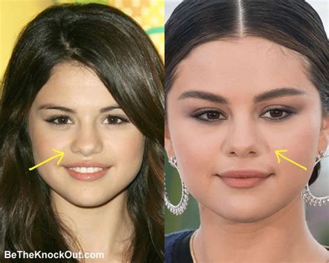 Selena Gomez Plastic Surgery Comparison Photos | Selena gomez, Plastic ...