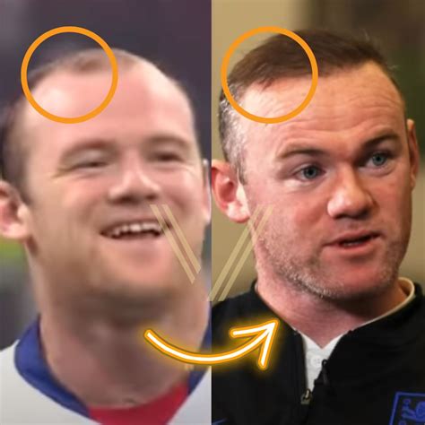 Wayne Rooney's Hair Transplant: Before and After Transformation