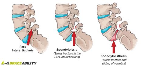 Spondylolysis of the Lumbar Spine: Symptoms, Causes & Treatments