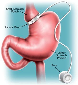 Band and Port Complications after Adjustable Gastric Banding | Dr ...