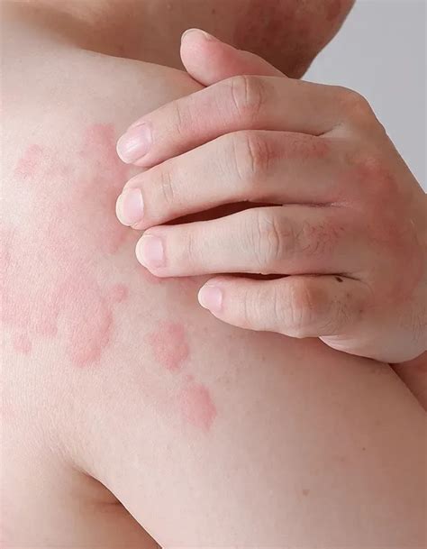 Hives for Tampa and Brandon, FL | Allergy, Asthma, & Immunology ...