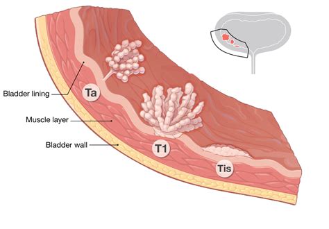 Melanoma Staging