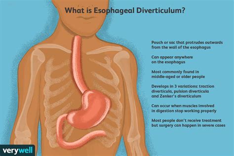 Esophageal Diverticulum: Anatomy, Causes, Significance