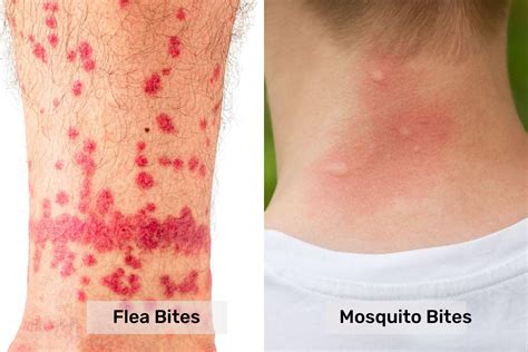 flea bites vs mosquito bites - Pest Control Gurus