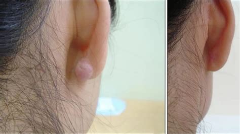 Keloid on ear: Causes, treatment, and prevention