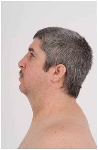 Dubowitz Syndrome Is a Complex Comprised of Multiple, Genetically ...