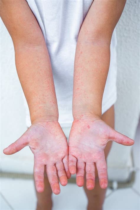 Enterovirus Leg - Arm - Mouth. Rash on the Body of a Child. Cocksackie ...