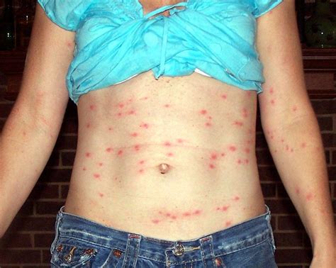 Chiggers (Mite) Bites, Rash Pictures, Treatment, Eradication ...