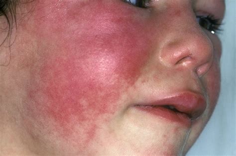 Red rash with fever