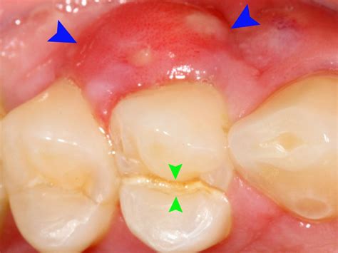 White Bump On Gums No Pain | Renew Physical Therapy