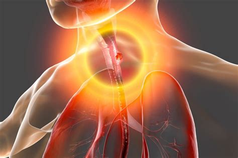 Four Disorders That Cause Dysphagia - LikeFigures