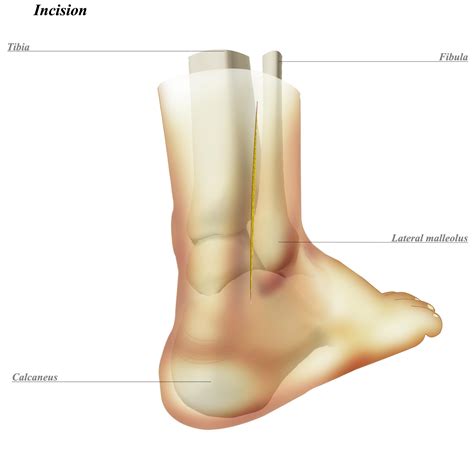 Lateral Malleolus