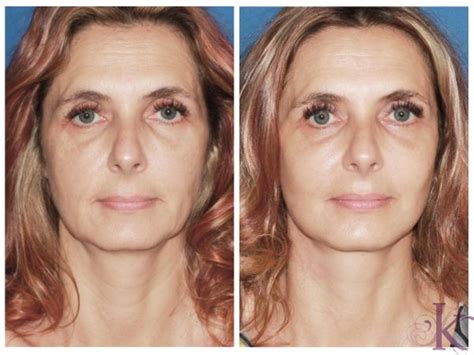 Mini Facelift Before and After Photo Gallery | New York, NY ...