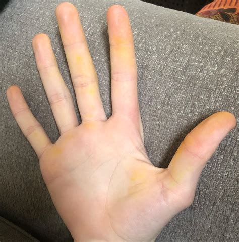 Why are both of my hands turning yellow? : r/medical