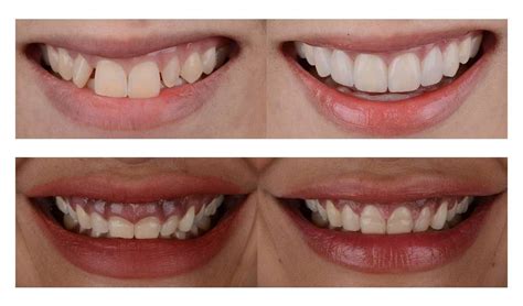 Transform Your Teeth with Clear Aligners: Before and After Pictures