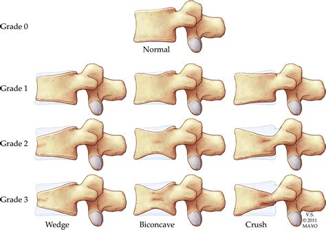 Imaging of Stress Fractures of the Spine - Radiologic Clinics