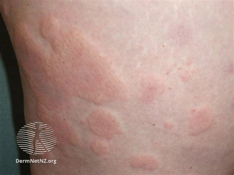 How Long Do Allergy Rashes Typically Persist?