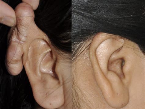 Ear Keloid Surgery - Mehta Plastic Surgery