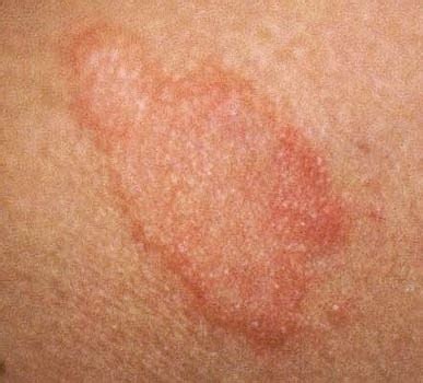 hepatitis rash - pictures, photos