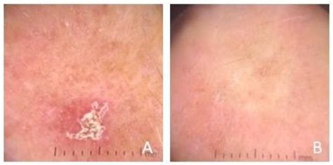 Fluorouracil Cream Before And After