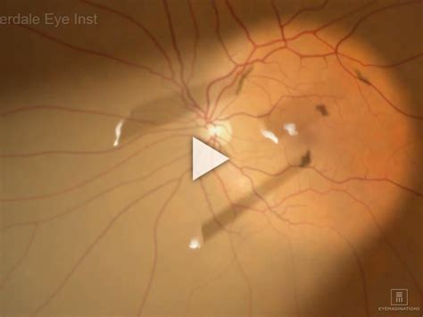 Vitreous Floaters Video | Fort Lauderdale Eye Institute