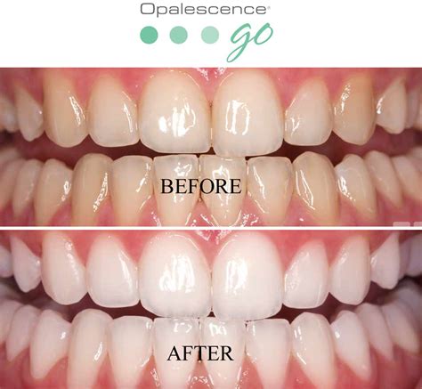 Teeth Whitening with Opalescence - Smile Care Dental Center