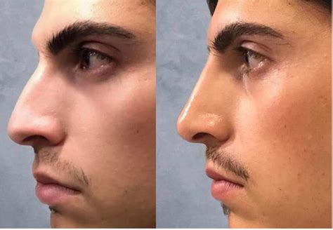 The Liquid Nose Job: Can You Reshape Your Nose Without Surgery? - https ...