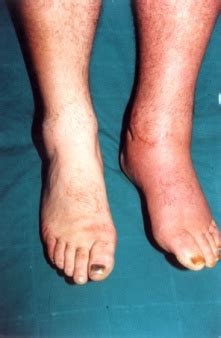 Clinical picture from patient with CRPS. | Download Scientific Diagram