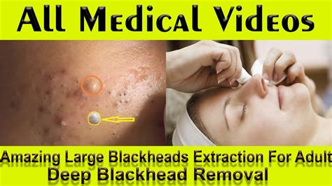 Blackhead Removal Videos May 2024 - Rhody Kristine