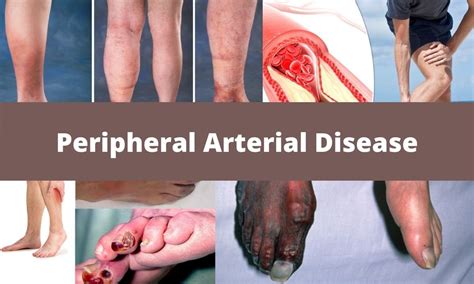 Lower Limb Peripheral Arterial Disease Diagnosis And Management ...