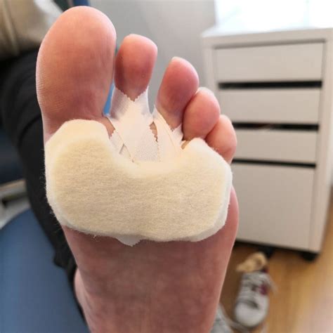 Plantar Plate Injury | Foot & Ankle Specialists in Kelso, Tweed Podiatry