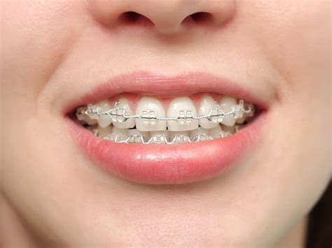 The Benefits of Clear Bracket Braces - Bangladesh Newspapers