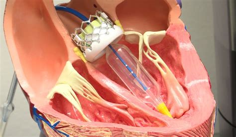 Admedus' shift to aortic valve replacement good news for younger patients