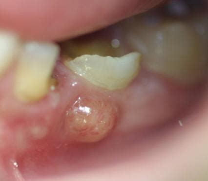 Tannabscess - Dental abscess - abcdef.wiki