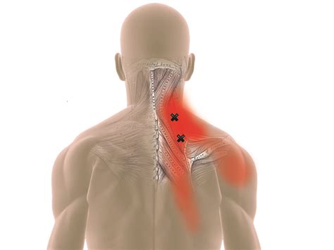 Levator Scapulae Trigger Points