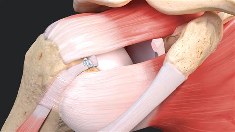 Arthrex - Proximal Biceps Tenodesis Using the Loop ‘N’ Tack™ Implant System