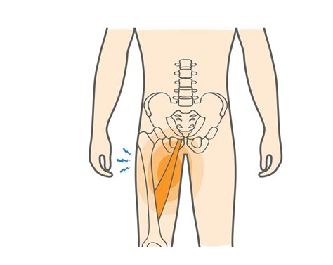 What is a Groin Pull & How to Recover from Such Strain? - Upswing Health