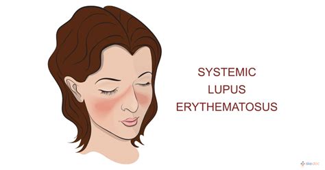 Systemic Lupus Erythematosus (SLE) | Symptoms, Treatment, and Causes