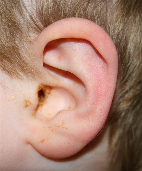 Understanding Ear Infection Symptoms: A Comprehensive Guide