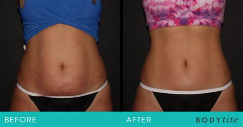 Body Sculpting: Before & After - Southeastern Dermatology