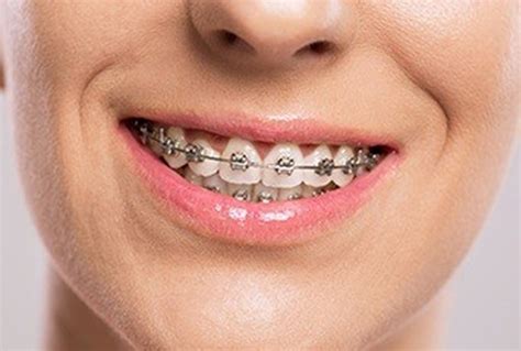 How Old Do You Have to Be to Get Braces? – Telegraph