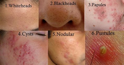 nodular acne vs cystic acne - Google Search Cystic Acne Treatment, Oily ...