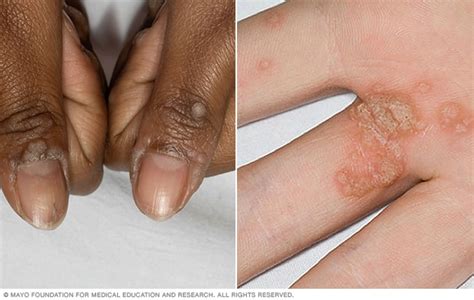 Common warts - Symptoms and causes - Mayo Clinic