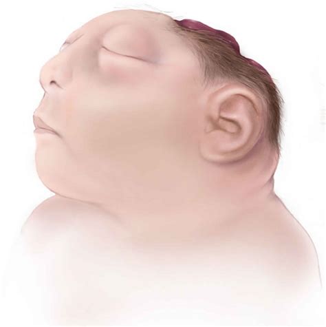 Anencephaly causes, symptoms, diagnosis, prognosis & anencephaly treatment