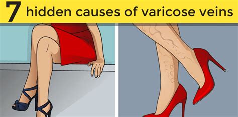 What Are The Causes of Varicose Veins