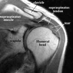 Repair of Rotator Cuff Tear with Stem Cells | Stem Cell Blog