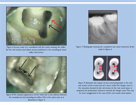 The middle mesial canal of mandibular first molars. | Semantic Scholar