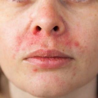 Perioral Dermatitis - Dermatologist in Lake Worth, FL | Palm Beach ...