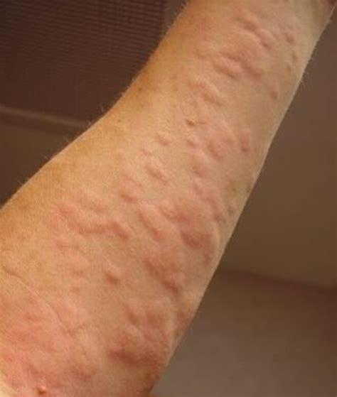 How Can You Get Hives — Natural Remedies | HubPages