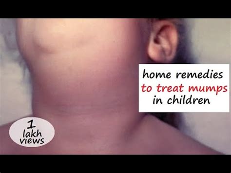 Home Remedies to Treat Mumps in Children II How to Get Rid of Mumps II ...